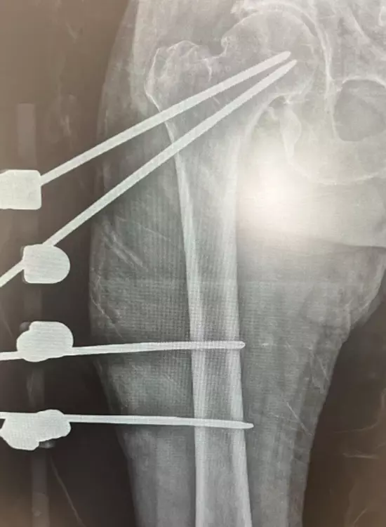 Dr. Alfredo Ortega Quiroz, Cirujano Ortopedista Traumatólogo, Alta Especialidad en Cirugía de Columna Vertebral