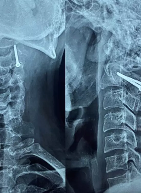 Dr. Alfredo Ortega Quiroz, Cirujano Ortopedista Traumatólogo, Alta Especialidad en Cirugía de Columna Vertebral